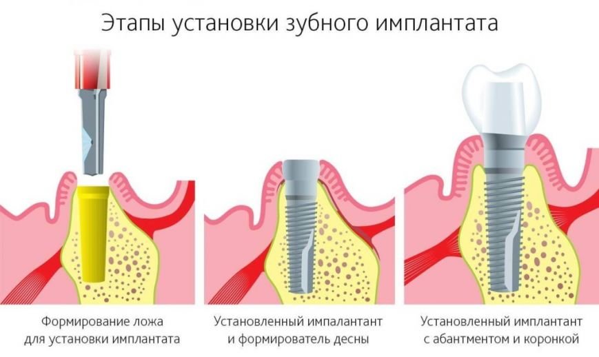 Стоит ли вставлять зубной имплант Стоит ли вставлять зубной имплант