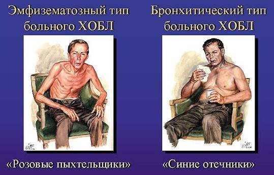 ХОБЛ1 ХОБЛ1