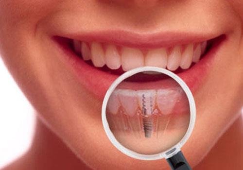 zubnye-implanty