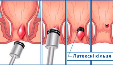 Vilikuvati Gemoroj Shvidko Ta Bez Bolyu Cilkom Realno Oksford Medikal Rivne