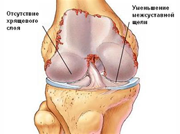 gonarthrosis
